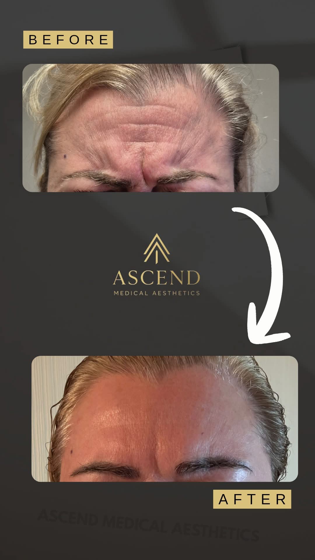Medical Aesthetics Before-and-after comparison of a woman’s forehead, showing deep frown lines in the before image and a smooth, wrinkle-free forehead after expert Botox Wigan treatment. Text reads ASCEND Medical Aesthetics. Wigan, Standish, Coppull, Charnock Richard